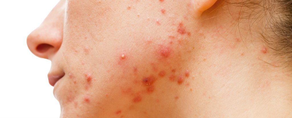 WHAT CAUSES THIS ACNE..